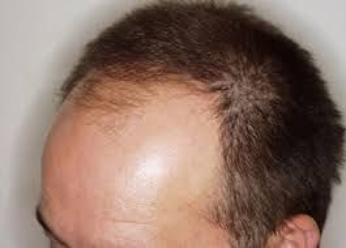 extraterrestre Sinceramente lámpara Alopecia androgenética en hombres
