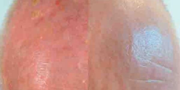 La calvicie, un factor de riesgo del cáncer de piel