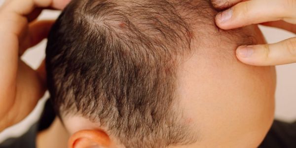 ¿Qué es la DHT? Todo lo que debes saber sobre esta hormona