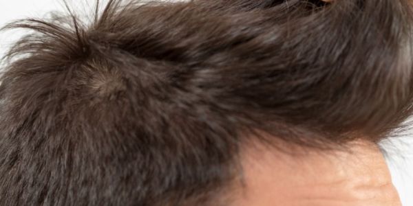 Caída capilar: qué ocurre realmente y cómo puede revertirse