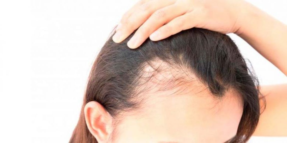 Síndrome del Poliquístico Alopecia femenina